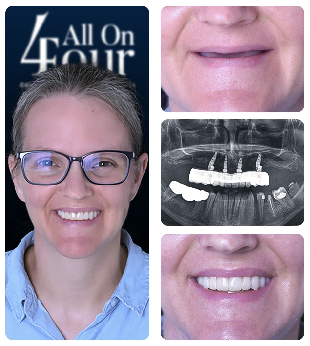 all on 4 dental implants cost mexico before after